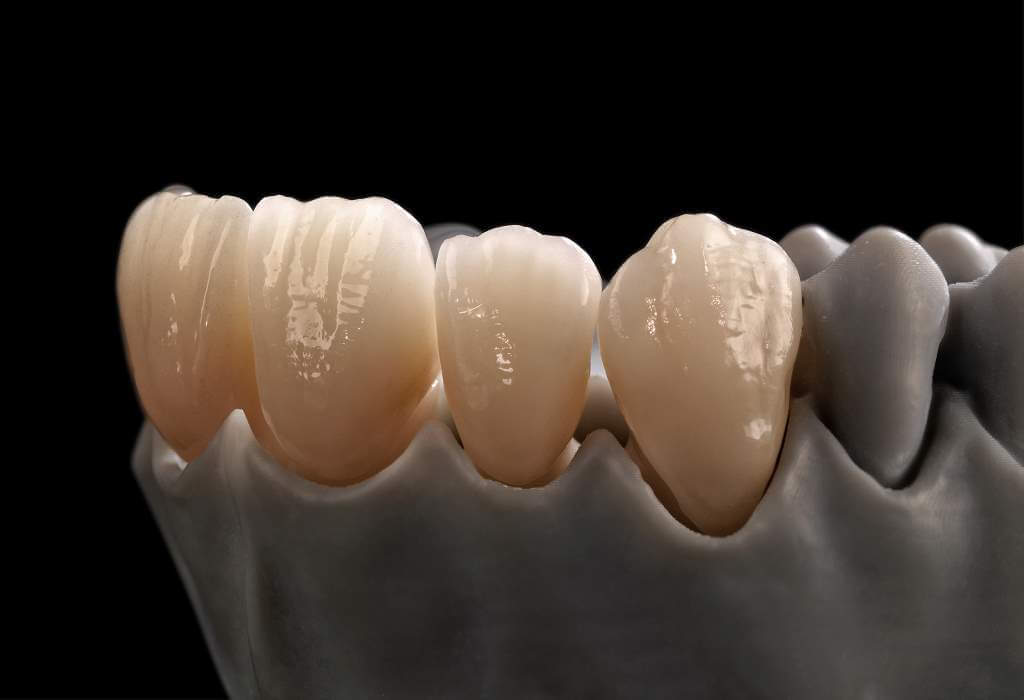 Ceramill Matik'te üretilen tipik diş protezleri